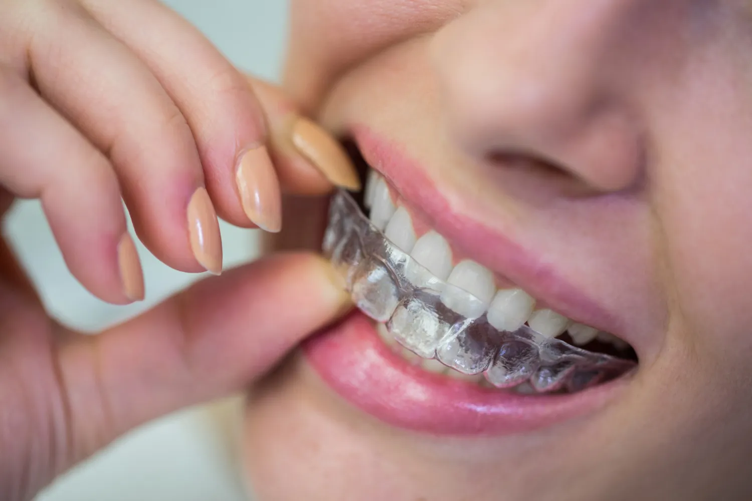 A close-up of a person inserting a clear dental aligner over straight, white teeth, showcasing neat, manicured nails.